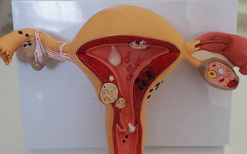 治疗排卵障碍有多种方法，常见的是药物治疗